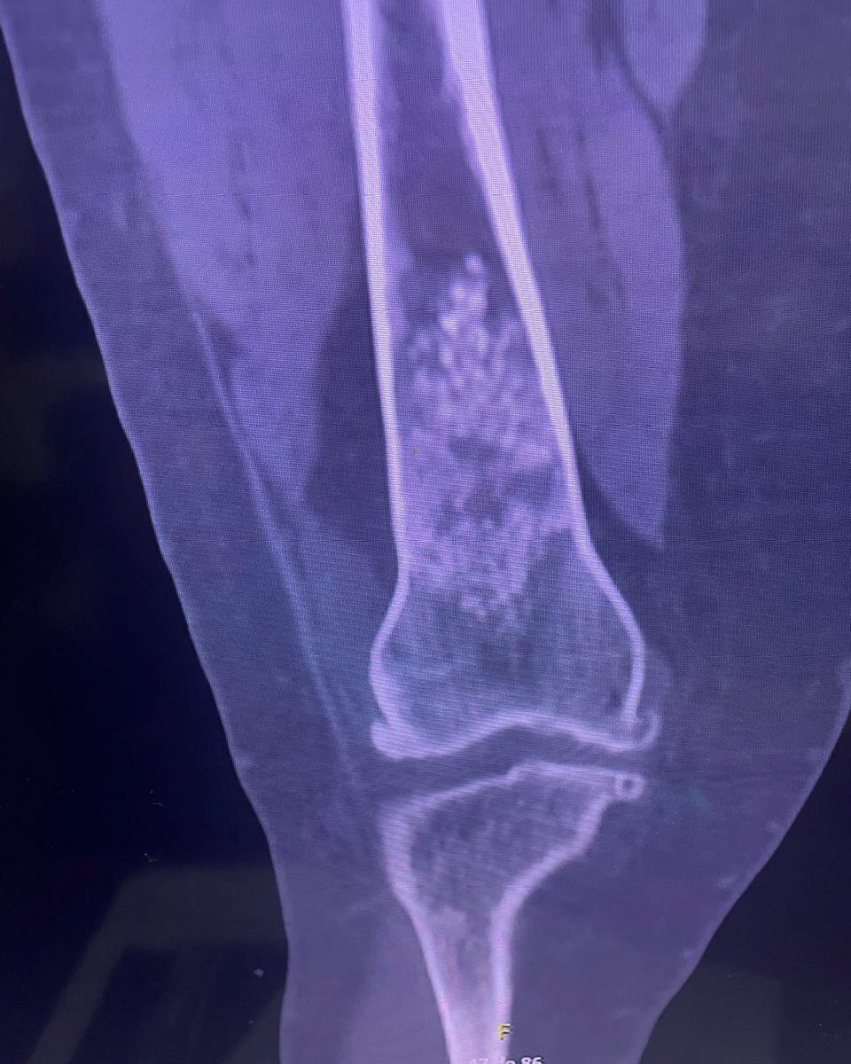 Diagnóstico avanzado de patología ósea